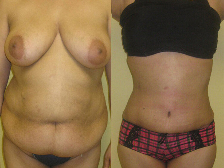 Before and After - Tummy Tuck