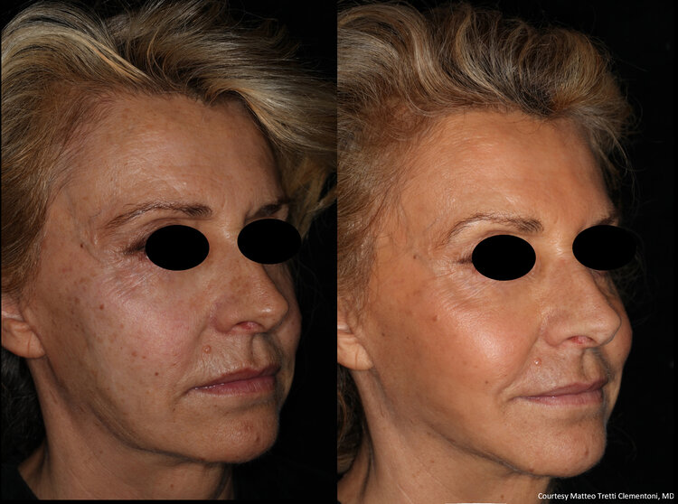Before and After - Microneedling