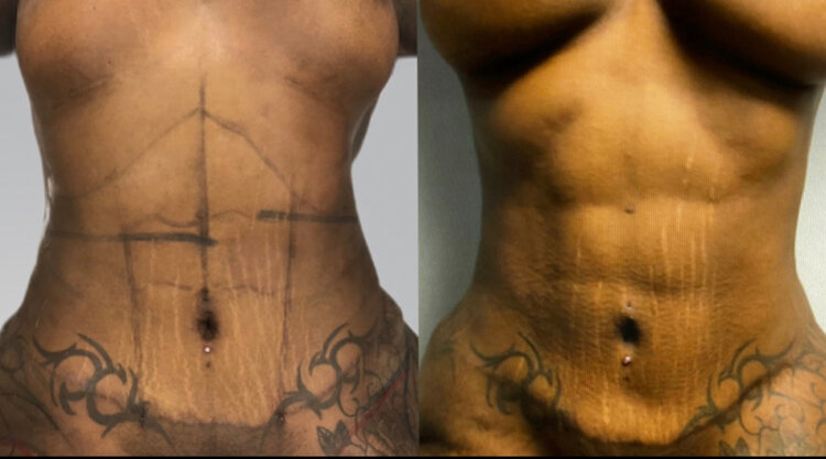 Before and After - HD Abdominal Etching