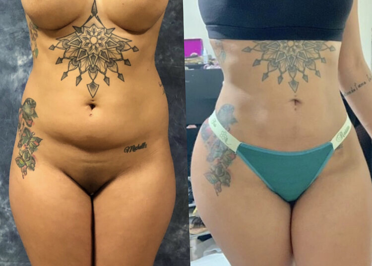 Before and After - HD Abdominal Etching