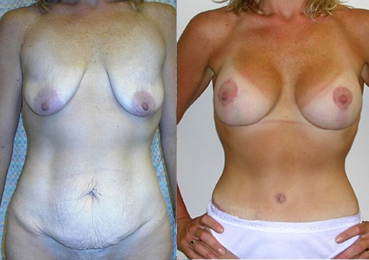 Before and After - Tummy Tuck