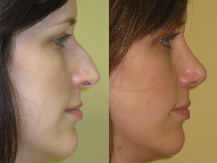 Before and After - Rhinoplasty