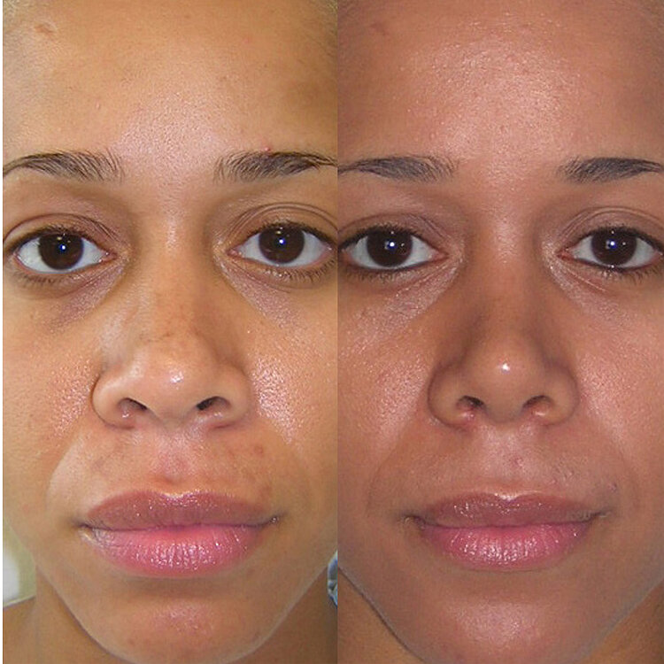 Before and After - Non-Caucasian Rhinoplasty