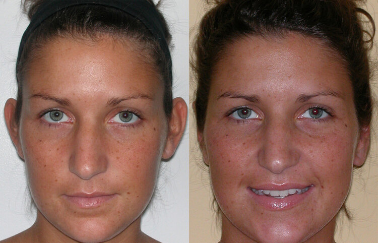 Before and After - Ear Surgery
