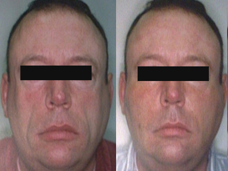 Before and After - Facial Fat Grafting