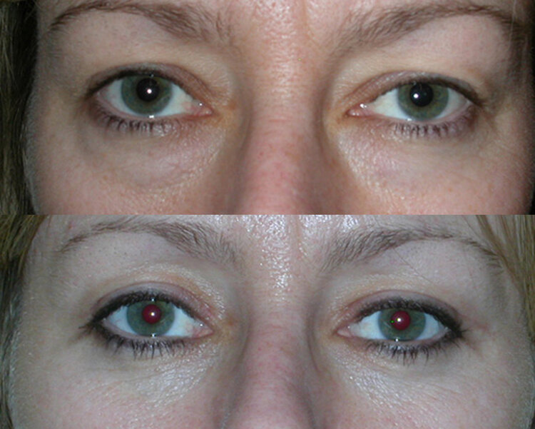Before and After - Eyelid Lift