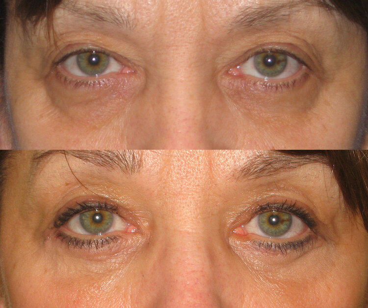 Before and After - Eyelid Lift