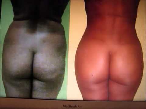 YouTube video titled BRAZILIAN BUTT LIFT IN THE THIN PATIENT - IS IT POSSIBLE?